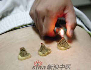 灸法的種類  你知道多少？
